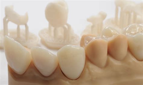 dental crown 3d printing